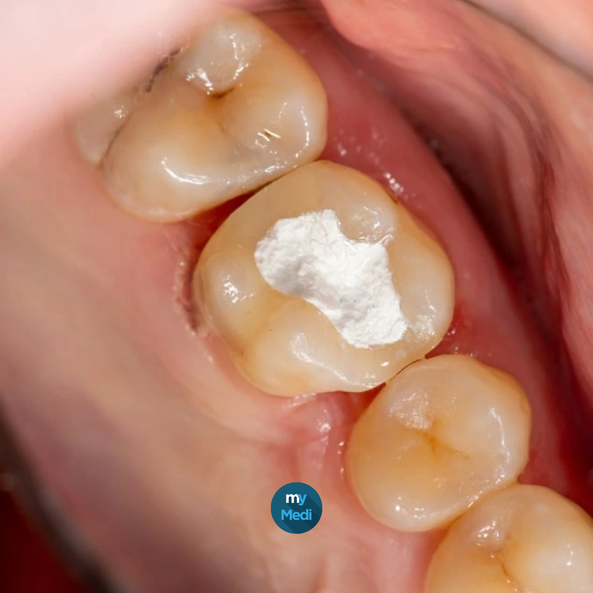 Ciments et médications endodontiques
