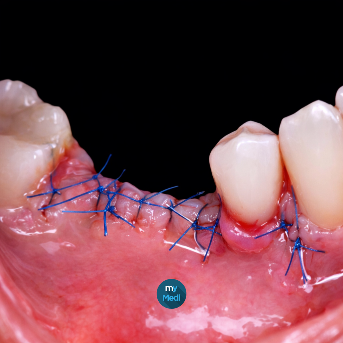 Sutures dentaires