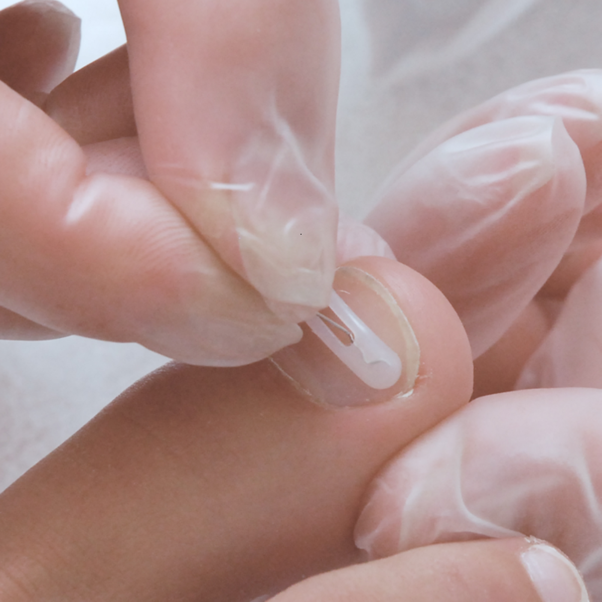 Languettes d’orthonyxie pour ongles incarnés et déformés - Différentes tailles - Podofix - My Médical