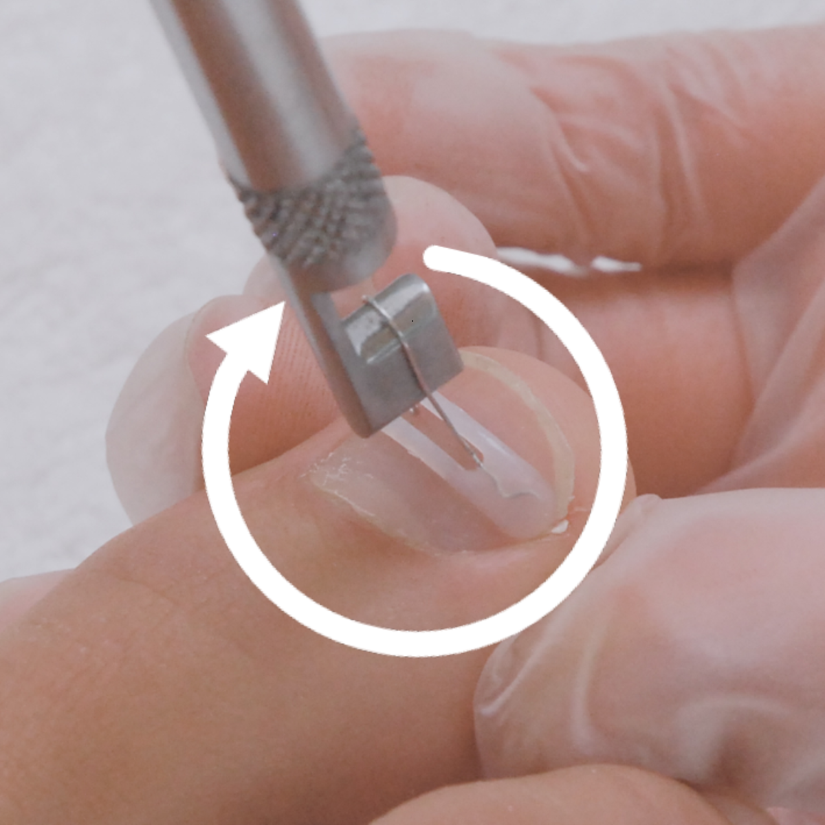 Kit complet d’orthonyxie pour ongles incarnés et déformés – Podofix - My Médical